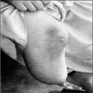Figura 10 – Ausência congênita da perna de uma garota da Birmânia, que disse lembrar-se da vida de uma jovem mulher acidentalmente atropelada por um trem, com sua perna direita atingida primeiro em relação ao restante do corpo.
