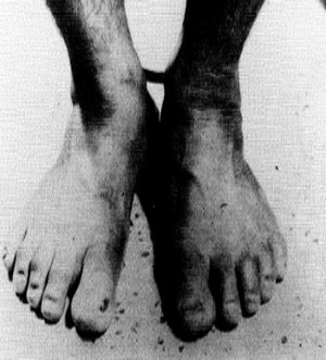 Figura 4 – Malformação congênita da unha no dedão do pé direito do sujeito tailandês mostrada na Figura 3.  Essa malformação correspondia a uma úlcera crônica do dedão do pé direito, da qual o tio do sujeito tinha sofrido.