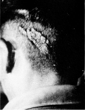 Figura 3 – Grande epiderme verrucosa na cabeça de um homem tailandês que quando criança disse que se lembrava da vida de seu tio paterno, morto com um golpe de uma faca pesada na cabeça.