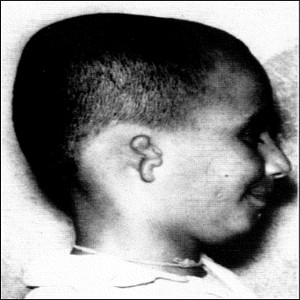 Figura 8 - Crânio severamente malformado de um menino turco que disse se lembrar da vida de um homem que foi fatalmente ferido no lado direito da cabeça por uma espingarda, descarregada a curta distância.